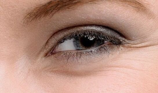 Wrinkles at the corners of the eyes